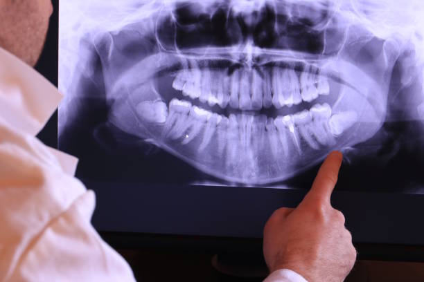 Best Emergency Root Canal Treatment in Pho, IL